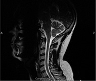 MRIの診断画像（イメージ）