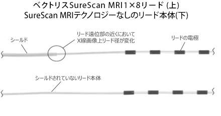 ベクトリスSureScan MRI1×8リード(上)