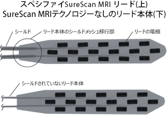 スペシファイSureScan MRI リード(上)