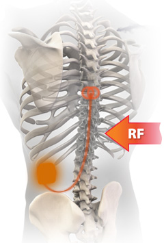 s電極周辺組織の発熱